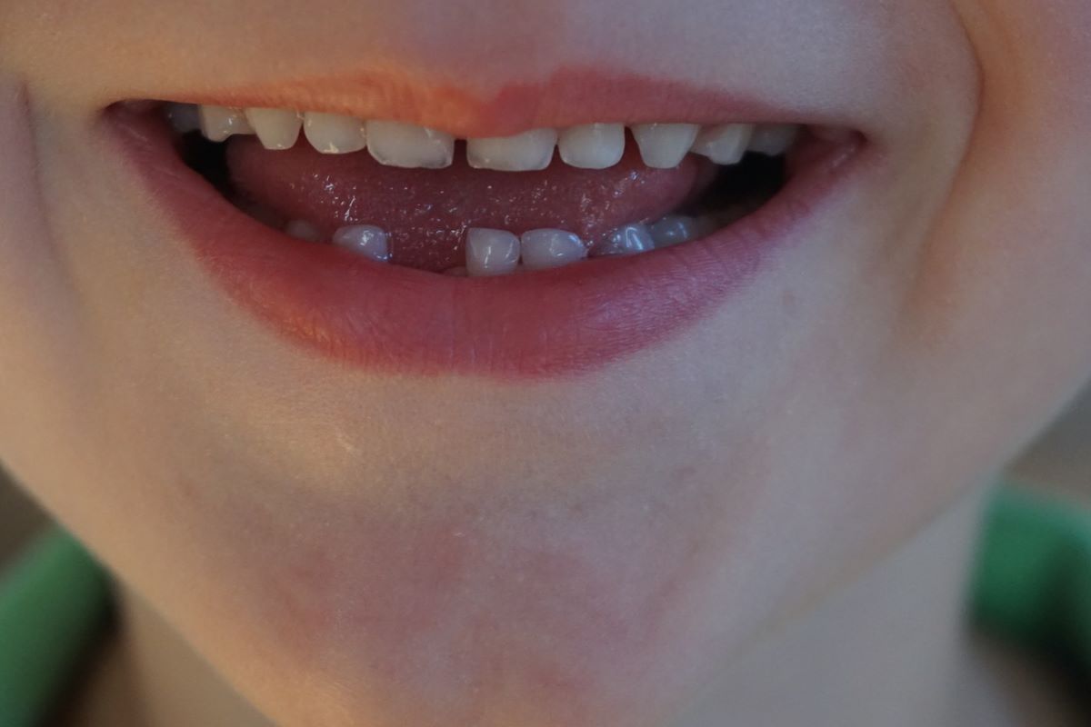 W jakim wieku wypadają zęby mleczne?