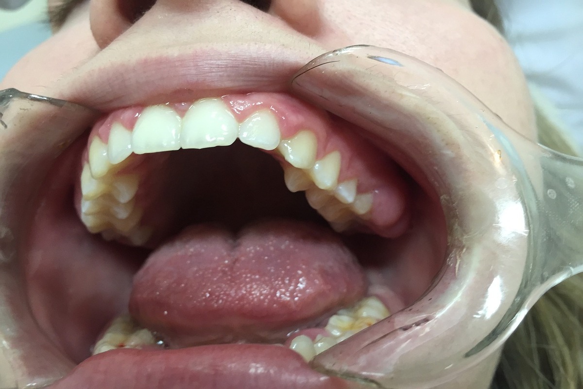 Co to jest kanał korzenia zębowego?
