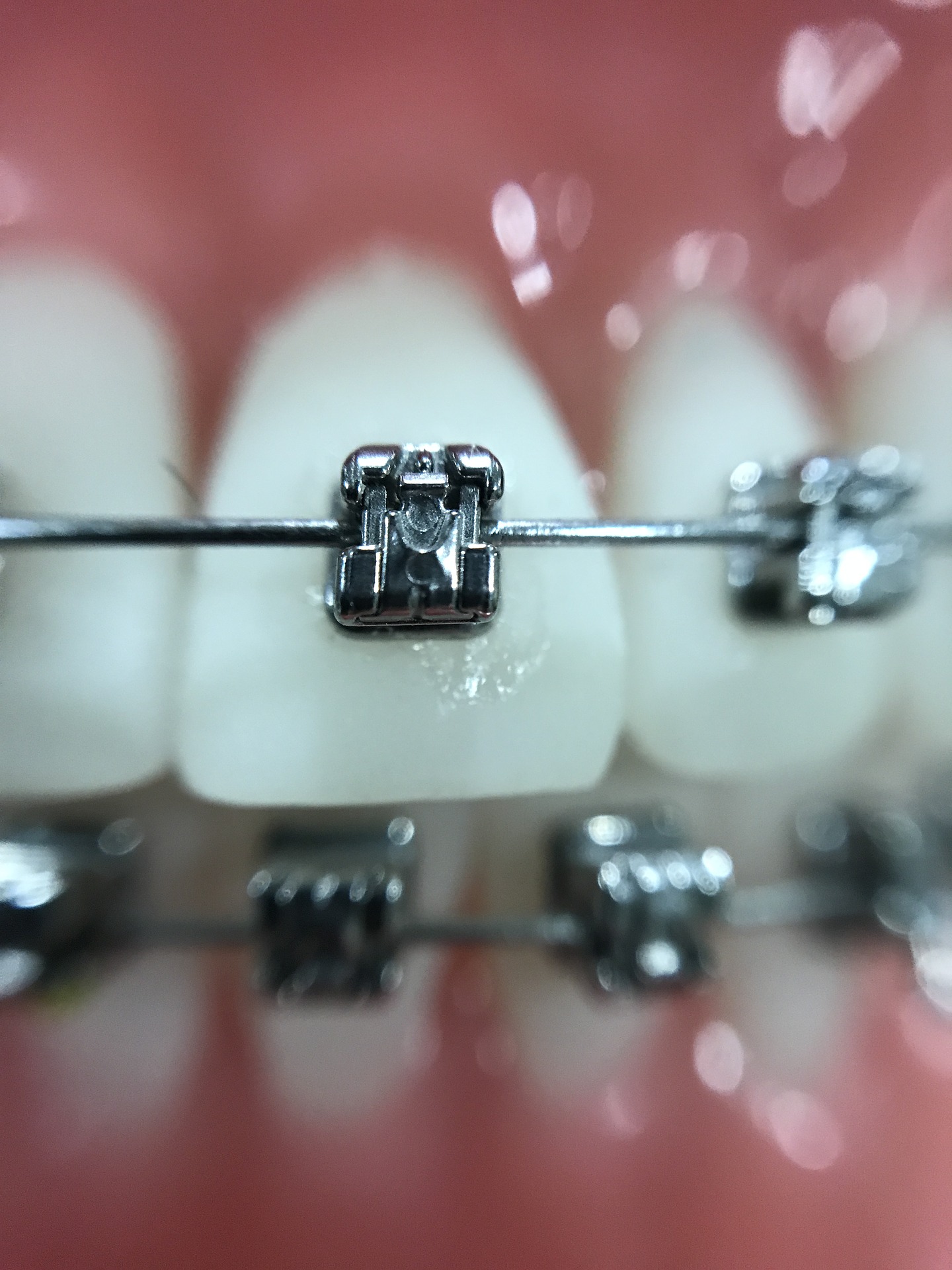 Jak dbać o ruchomy aparat ortodontyczny?