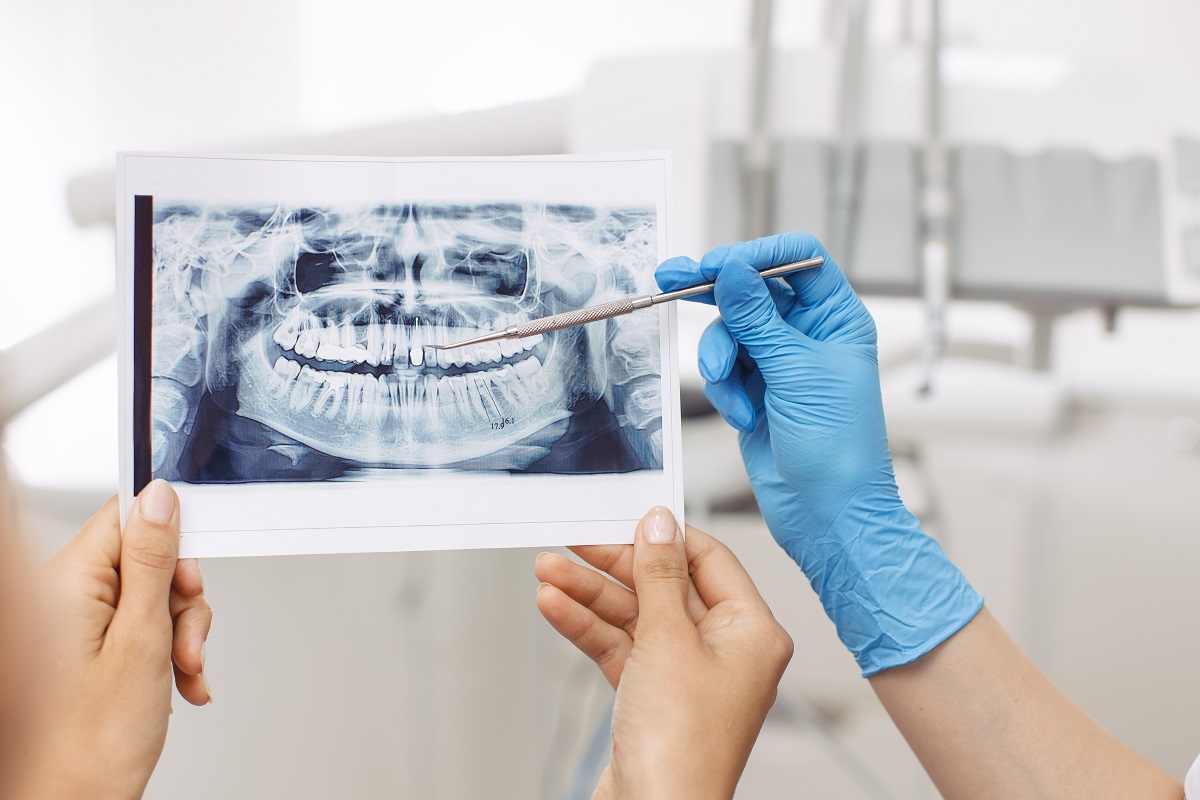 Czy implanty stomatologiczne trzeba wymieniać?