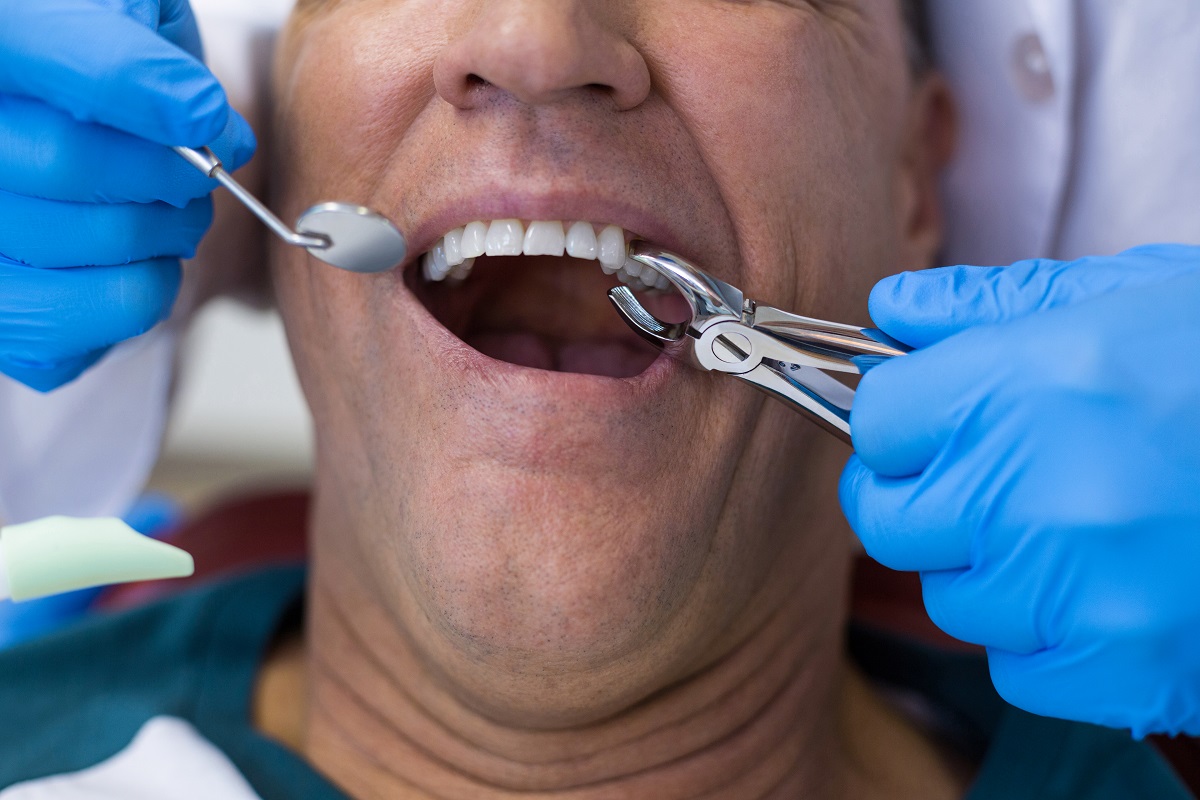 Kiedy konieczne jest usunięcie zęba?