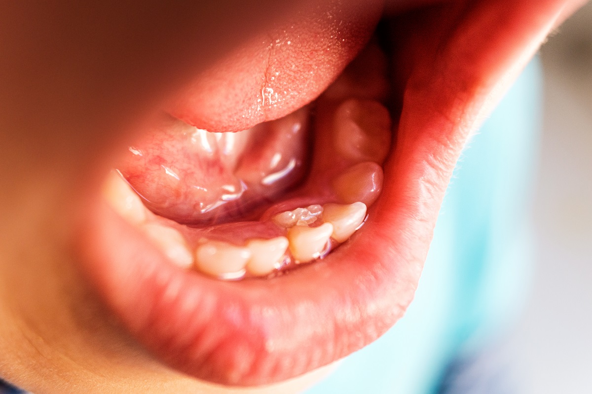 Ząb rośnie na dziąśle u dziecka – co robić?